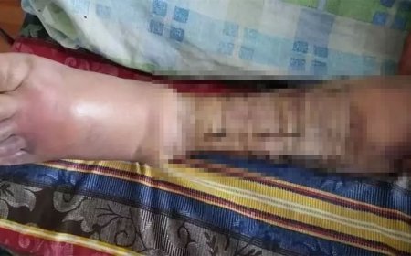 Сэрэмжлүүлэг: Хугарсан хөлөө өөрөө чиг барьж боосноос болж хүндэрчээ