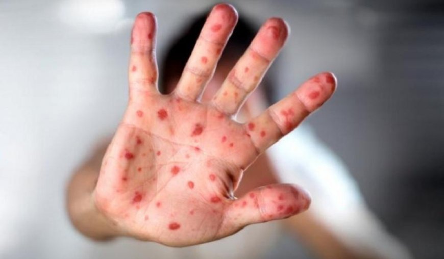 УЛААНБУРХАН ӨВЧНИЙ НИЙТ БАТЛАГДСАН ТОХИОЛДОЛ 13.663 БОЛЖЭЭ