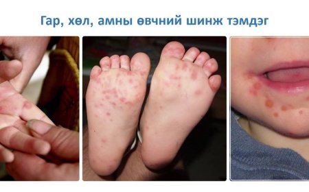 ХҮҮХДЭД ДАРААХ ШИНЖ ТЭМДГҮҮД ИЛЭРЧ БУЙ ЭСЭХИЙГ АНЗААРААРАЙ