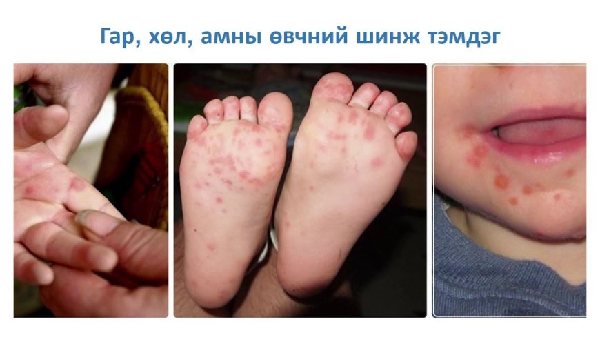 ХҮҮХДЭД ДАРААХ ШИНЖ ТЭМДГҮҮД ИЛЭРЧ БУЙ ЭСЭХИЙГ АНЗААРААРАЙ
